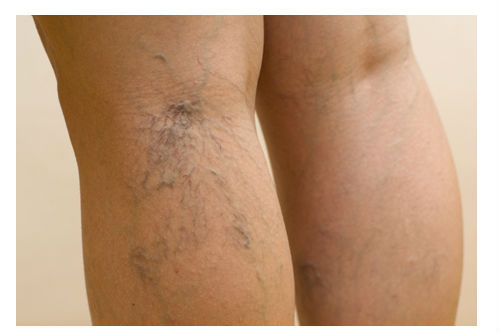 Read more about the article Proširene vene na nogama i njihovo lečenje