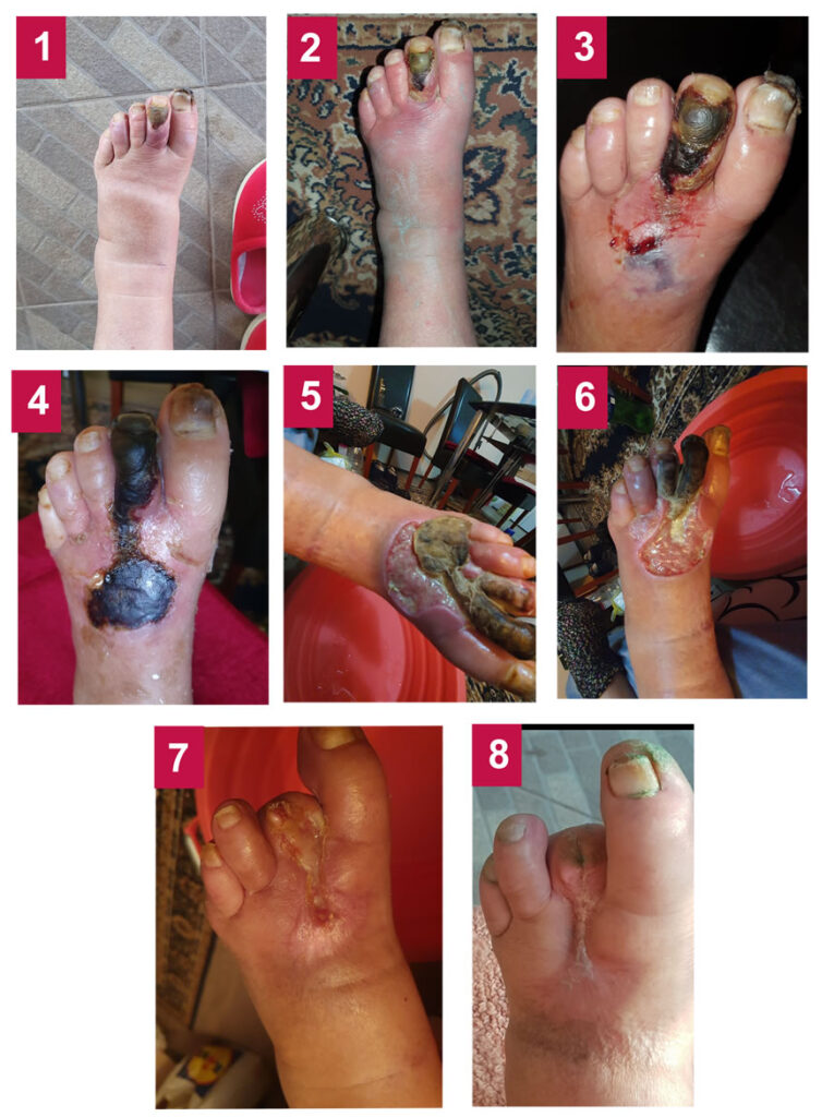 Proces zarastanja rane kod gangrene nakon amputacije prsta