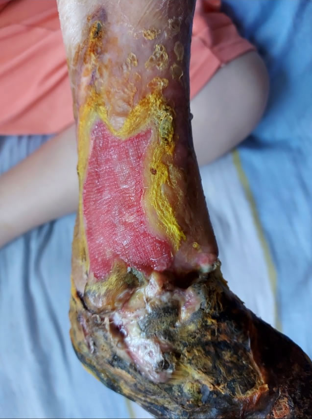 Gangrena noge nakon 3 meseca upotreba Venovin preprata
