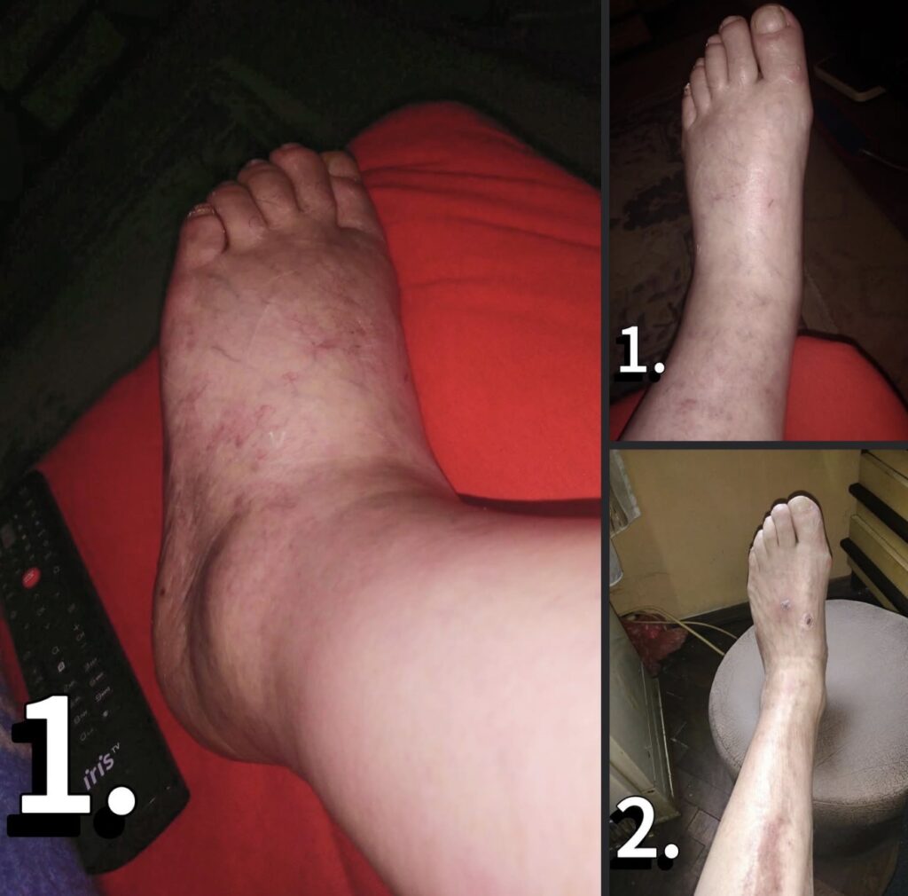 otečena noga i sprečena amputacija